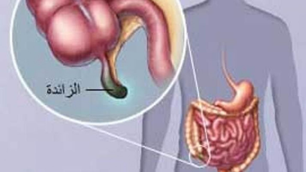 كيف أعرف إني مصاب بالزائدة ؟ 